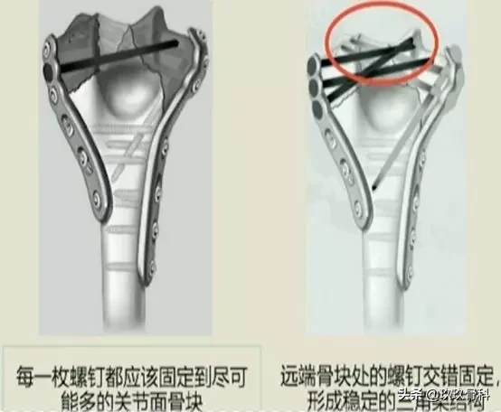 肱骨远端骨折的分型和治疗原则