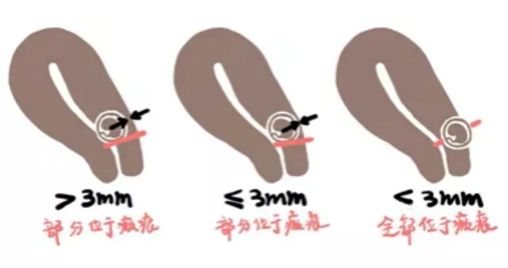 有喜却不是好孕，有一种危险叫子宫瘢痕妊娠！教你三招远离它