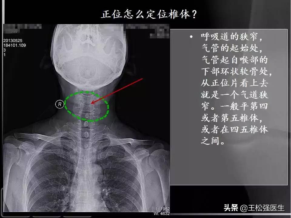 颈椎X光片