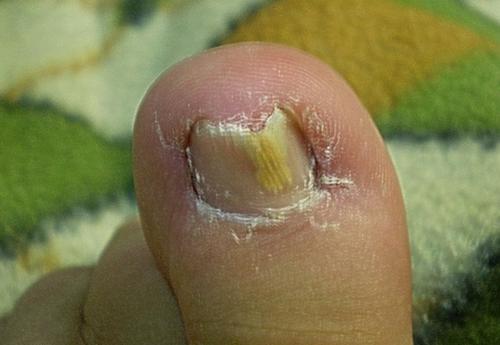 皮肤科:灰指甲病人接触孩子时需戴手套,以免真菌感染给孩子