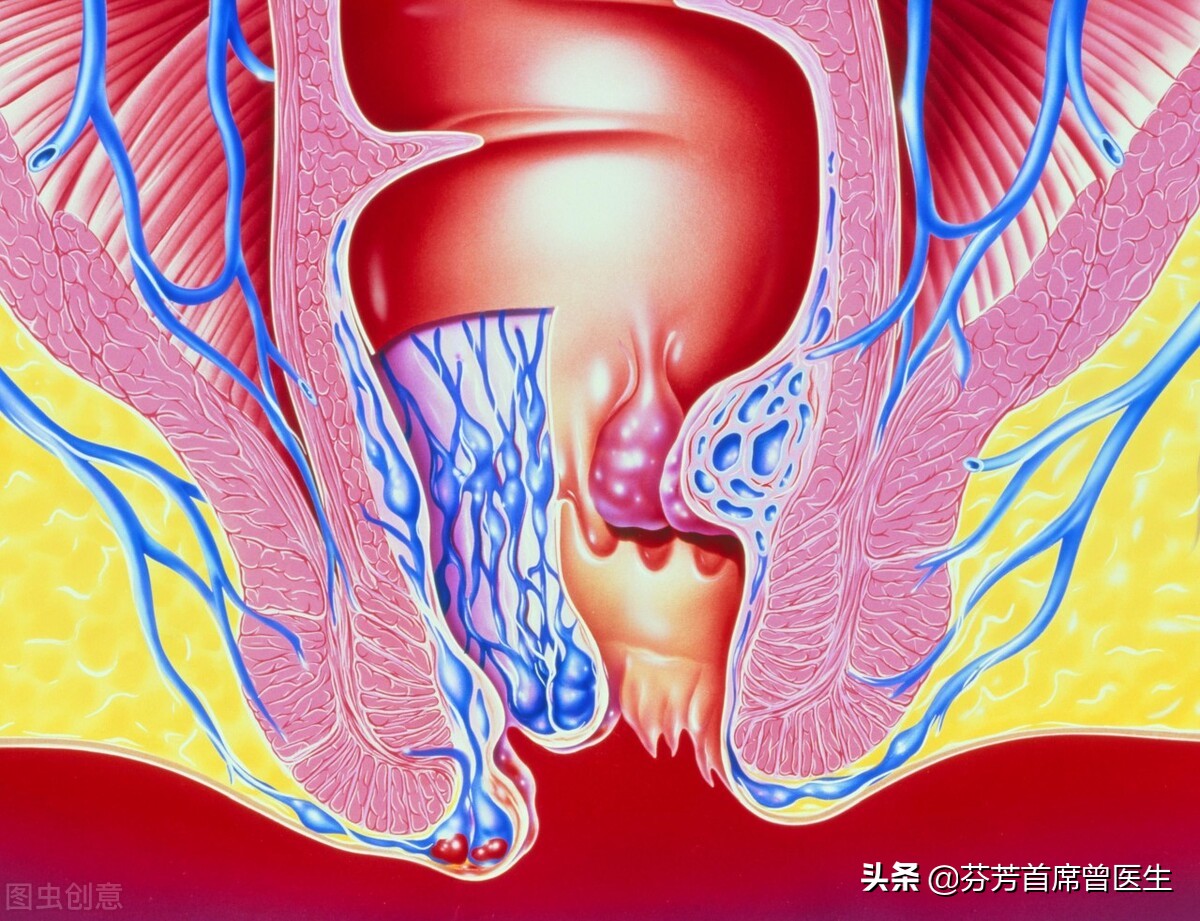 痔疮发作要做手术，到底是传统手术好，还是选择PPH手术？