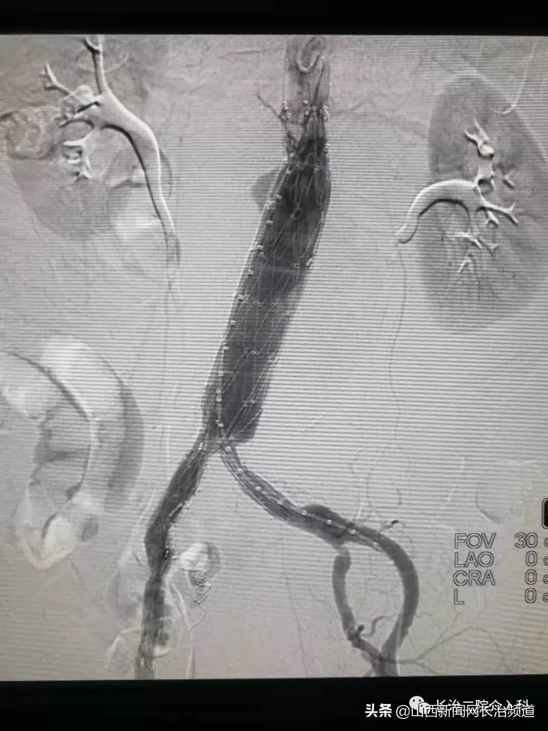 山西甲下血管球瘤哪里做的好(长治二院介入科顺利完成首例巨大腹主动脉瘤腔内隔绝术)