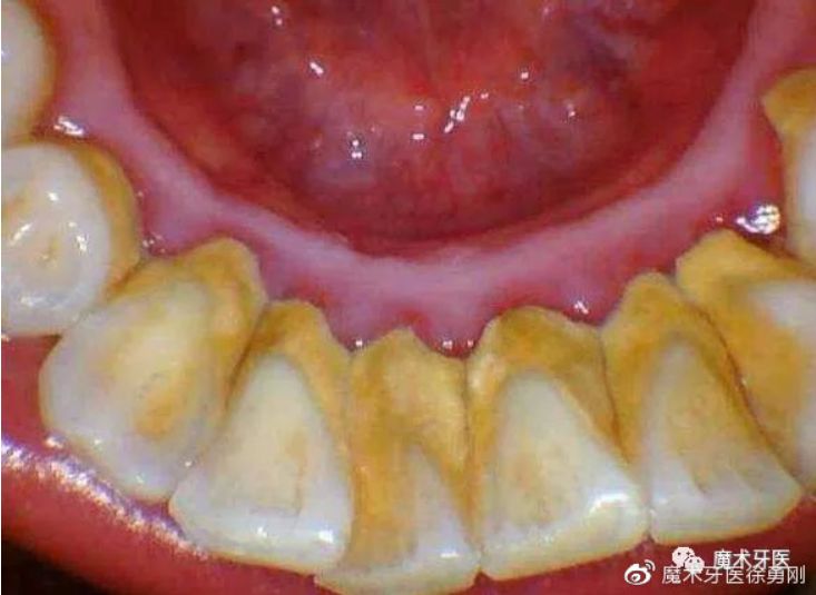 牙周炎，国人后半生无法摆脱的痛