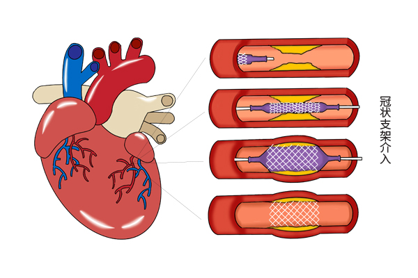 心脏支架价格“大跳水”，意味着质量变差了？和患者们讲大实话