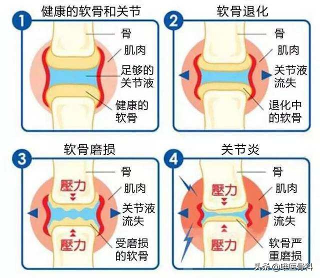 关节炎打玻璃酸钠作为“润滑针”，到底有没有用？