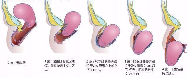 不同程度的盆腔脏器脱垂（4）肥胖: 可造成腹压增高→膀胱内压增高→尿道