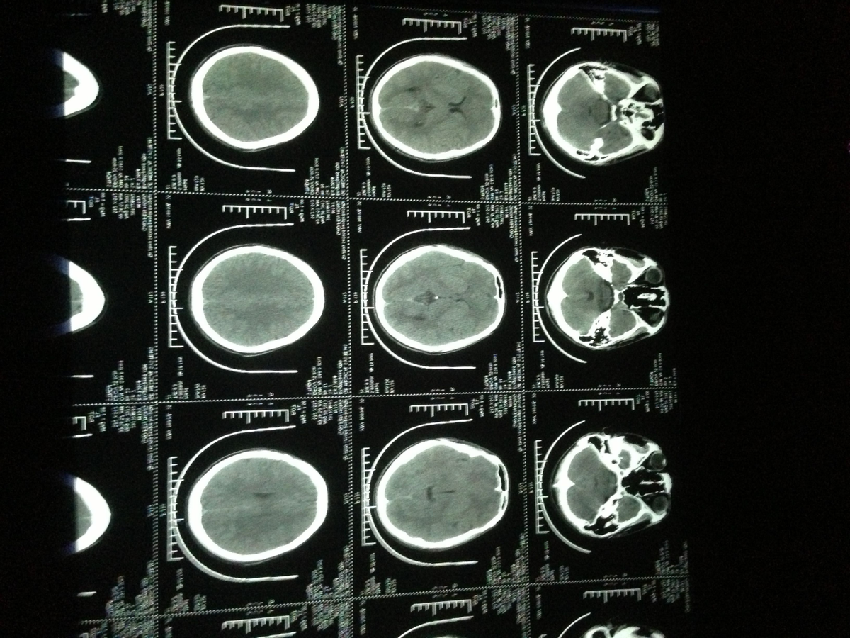 做一次CT，对人的影响到底有多大？医生说出了心里话