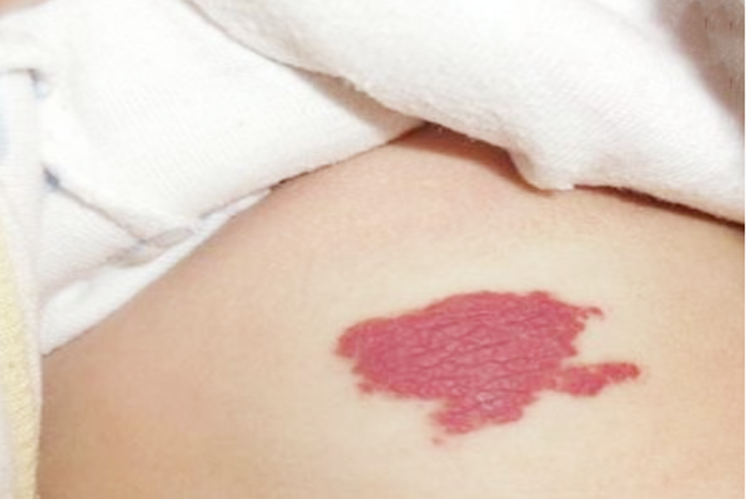 新生儿红胎记症状图片图片