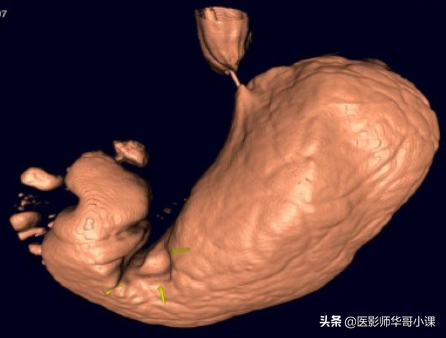 胃，3D立体重建技术，还您一个实实在在的胃。网友：价格多少呢