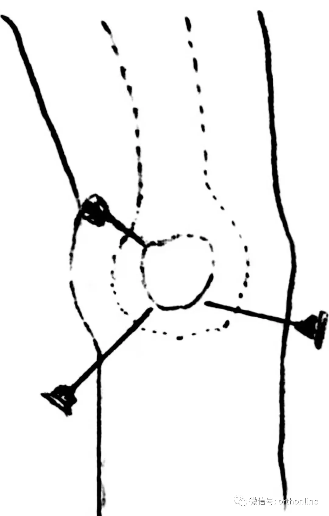 临床实用 | 关节穿刺技术分享