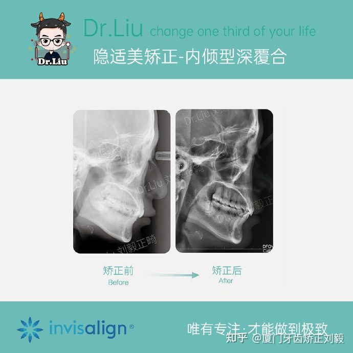 厦门牙齿矫正：「隐适美矫正-内倾型深覆合案例」