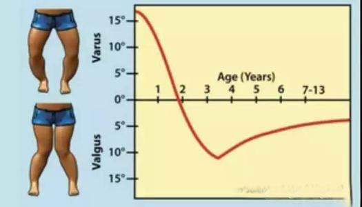 小学生踢足球会不会o型腿(为什么我孩子的腿不直呢？怎么办呢)