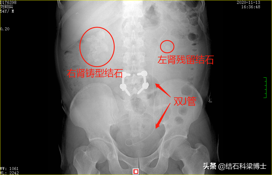 震惊！大叔双肾结石手术不彻底，苦等6月无果，正生专家收拾残局