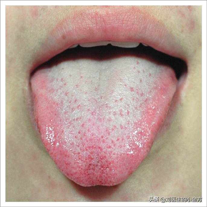 《中医舌诊》,26张临床高清舌诊图,附带解析,史上最全!