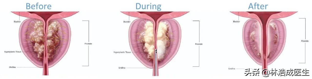 保留性功能的前列腺增生手术选择