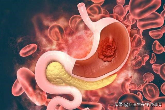胃黏膜受损如何修复？缓解烧心反酸与胃部不适的方法