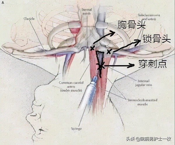 锁骨下静脉穿刺置管术,锁骨下静脉穿刺置管术定位