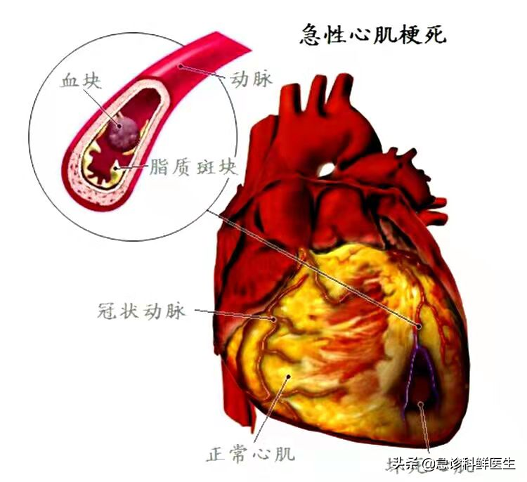 心脏支架手术，到底是治病救人，还是缺德害人？医生告诉你真相