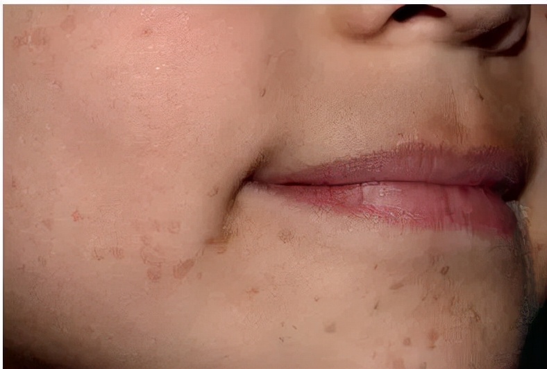 眼周的小颗粒,究竟是什么玩意?