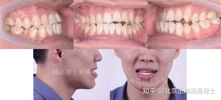 北京正畸杨磊博士：骨性反颌偏颌患者