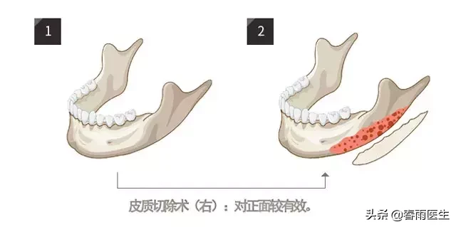 天下所有的削骨手术都会导致“脸垮”吗？