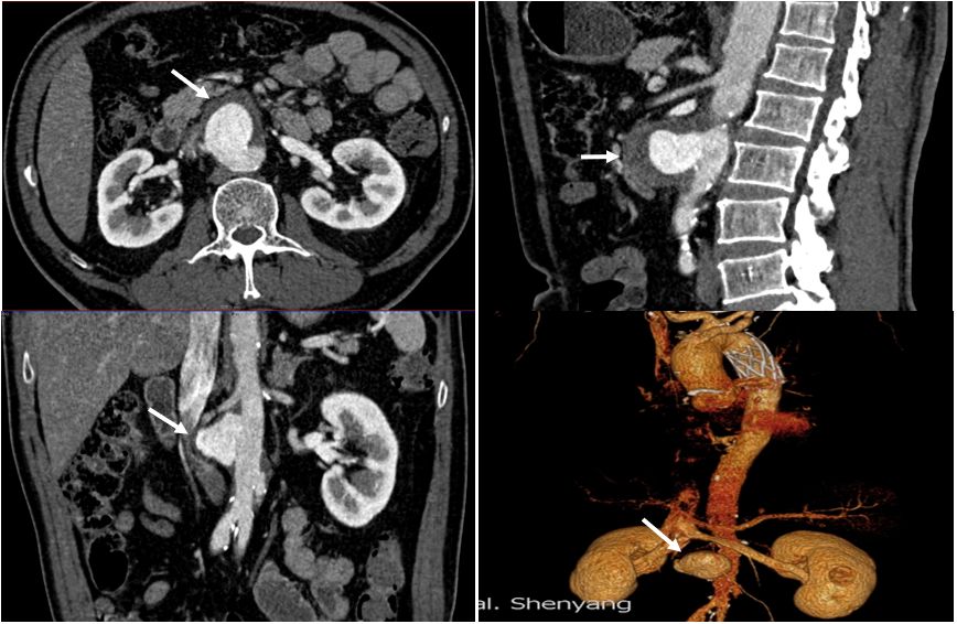8小时完成高危病症手术，让患者一周出院，中国医大一院又实现新的突破！