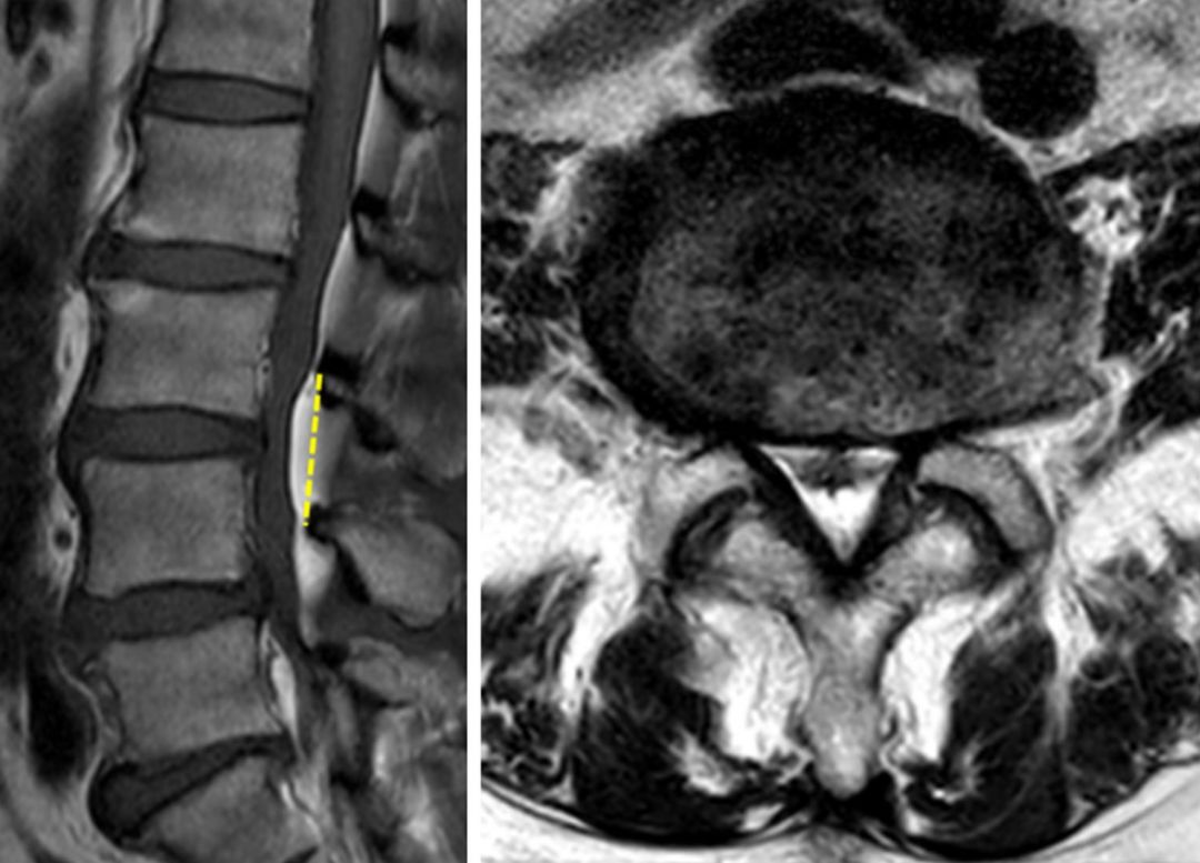 从诊断到治疗：全面解析腰椎峡部裂(lumbar spondylolysis)