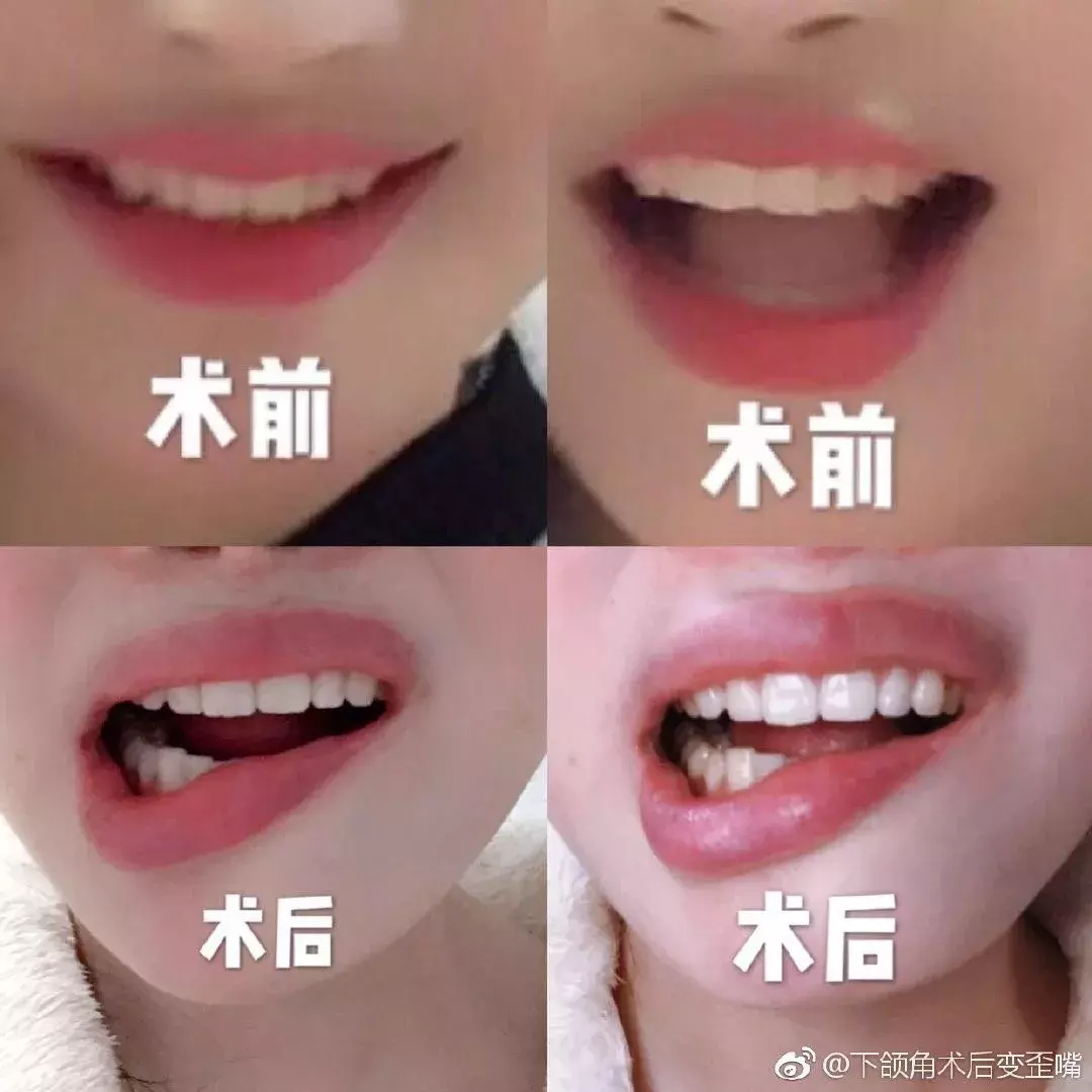 毁一生!25岁姑娘整容致十级伤残,嘴歪成这样……医院只赔5000元