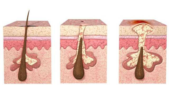 九个闭口形成的原因!好皮肤才是仙女的本钱来一起变美吧