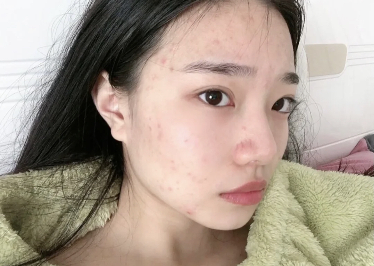 什么样的女生容易"长痘"?从这几点就能判断,希望你不是