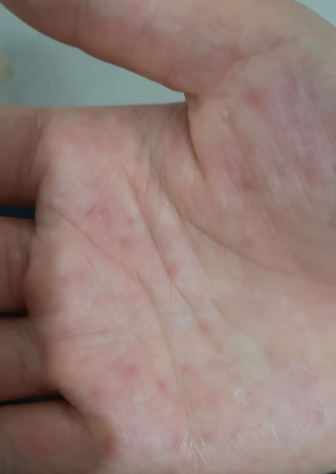 「汗疱疹」如何根治？与湿疹、手足癣的关系？都解答在这里了
