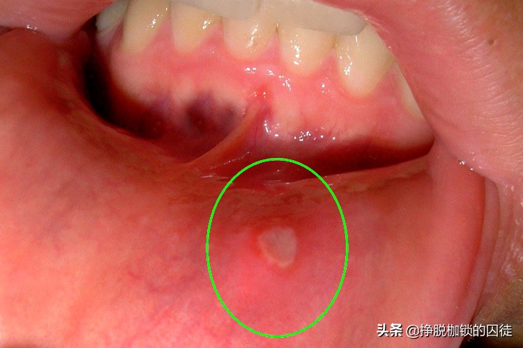 经常口腔溃疡怎么办 口腔溃疡缓解方式