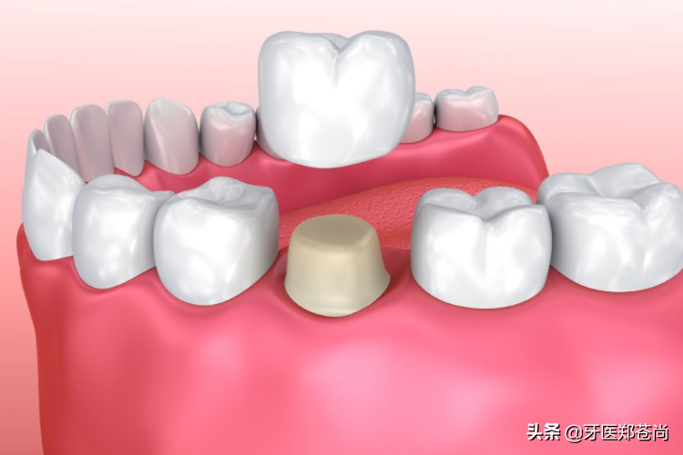 牙齿磕到了断了一半，现在想补好补吗？