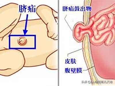 婴儿脐疝处理（婴儿脐疝应该怎么办）