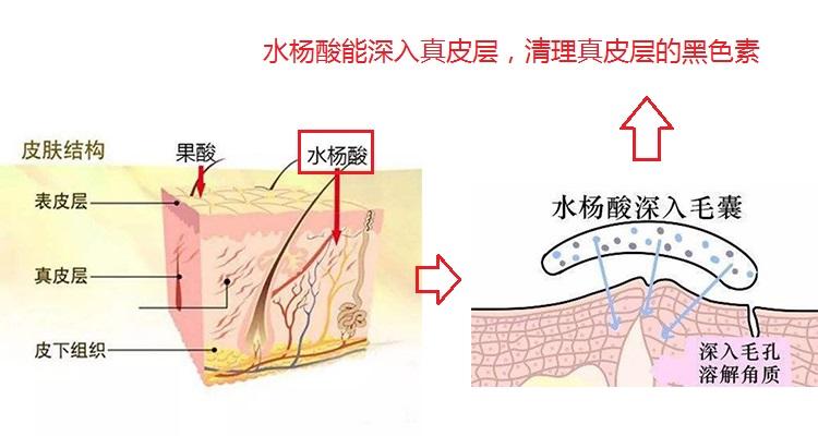 黑色痘印太烦恼？3步彻底去除印痕，恢复白嫩水光肌