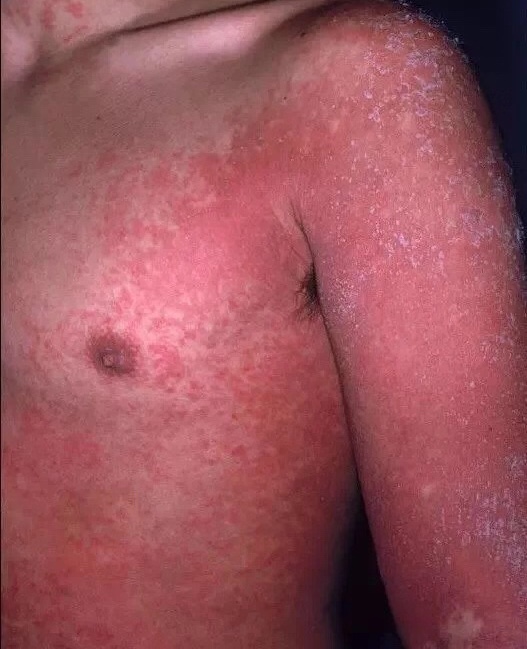 是a族溶血性链球菌感染导致的