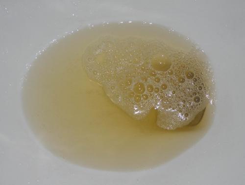 尿液中有白色沉淀物是什么原因(有泡沫尿就是肾脏出现问题了吗) - 百