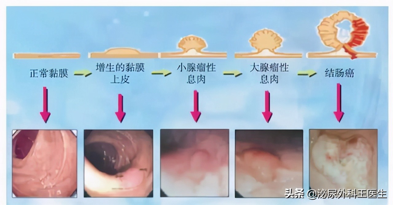 一天3、4次大便，便血5个月，男子查出肠癌晚期：有病不能拖