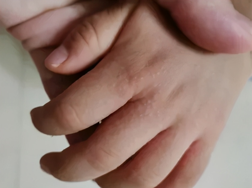 孩子手上起很痒的小疙瘩，是什么？怎么办？