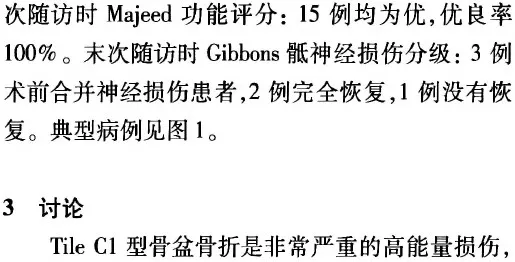 骨盆外架辅助复位联合通道螺钉固定治疗Tile C1型骨盆骨折