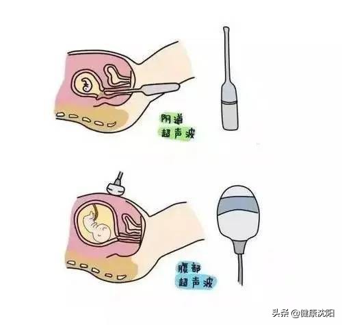 健康科普堂 | 肚子疼流血都查它，阴式超声到底有多神？