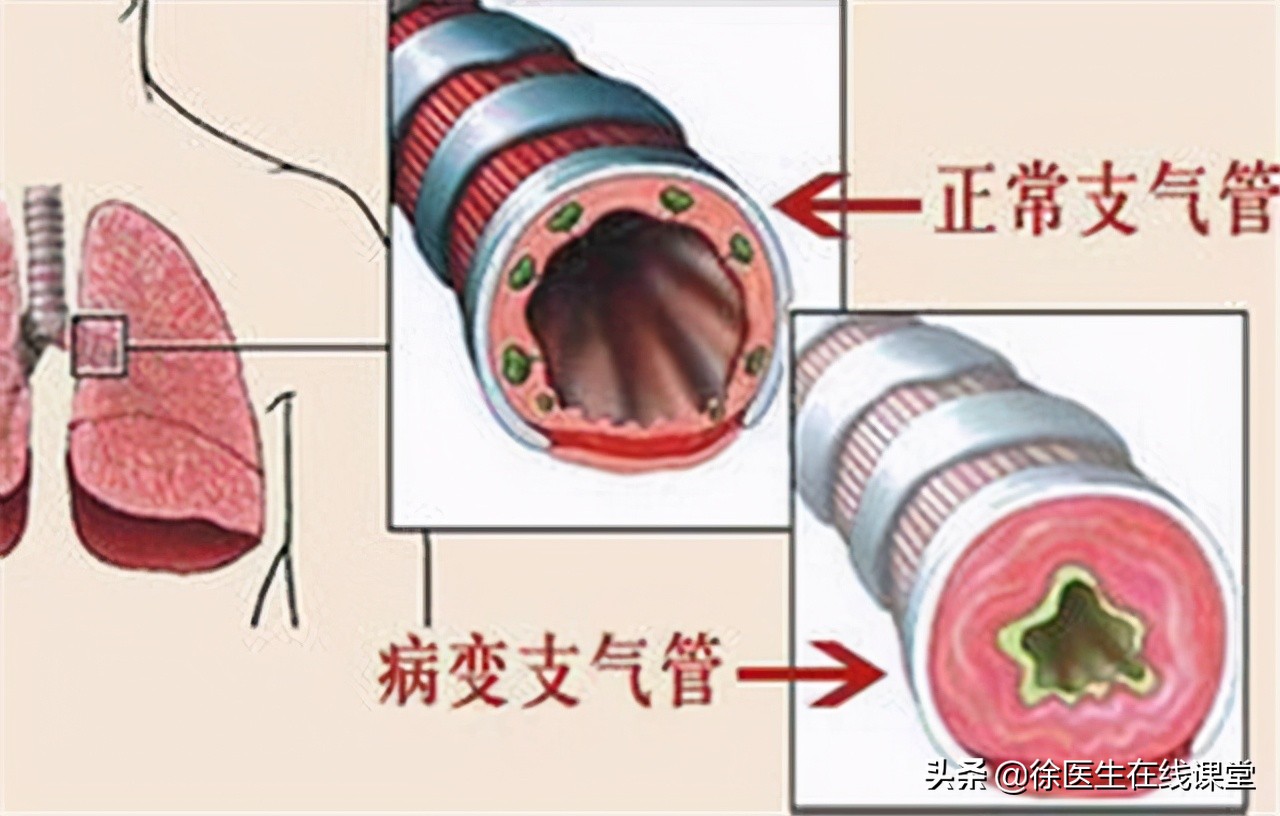 怀疑得了哮喘需要做哪些检查？要如何治疗？