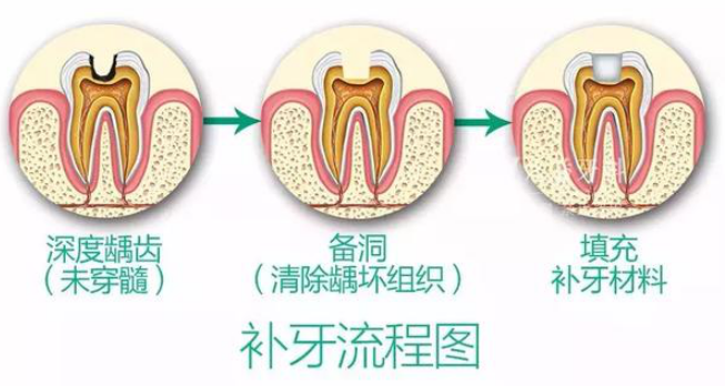 牙齿缺损后需要补牙，补牙材料这么多？怎么选才能又便宜又好用？