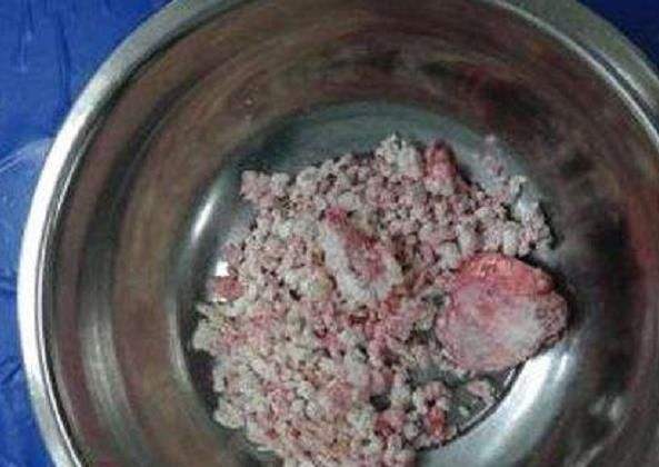 医生从我体内取出一盆石头，都是痛风惹的祸！痛风石怎么治疗？