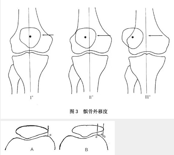 左髌骨内侧支持带损伤(「髌骨软化」这个病，绝大多数人都搞错了。骨科医生告诉你真相)