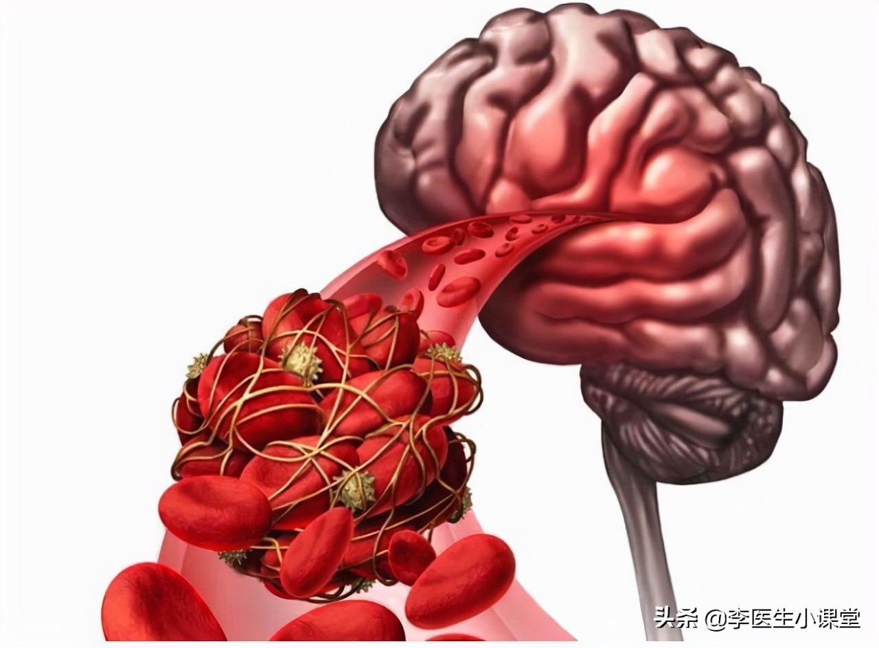 脑供血不足如何改善？日常调理与医疗干预方法