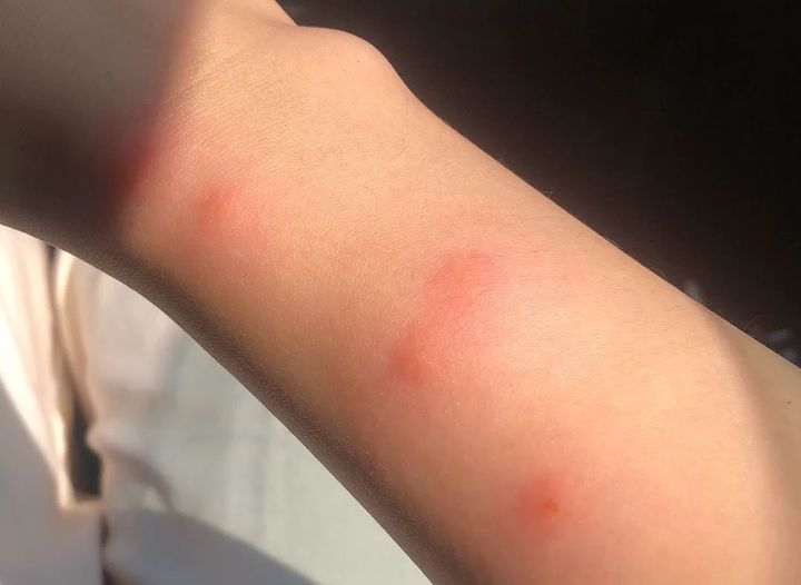 手臂小腿起红色小包,可能是丘疹性荨麻疹