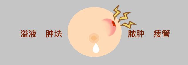乳腺结节到底是什么? 真相在这里！