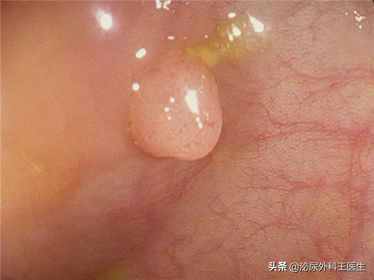 大便呈颗粒状且每日排便三次是怎么回事？