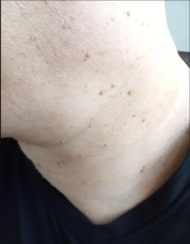 颈部长小肉球，抠掉会怎么样，如何处理，医生给你说明白了